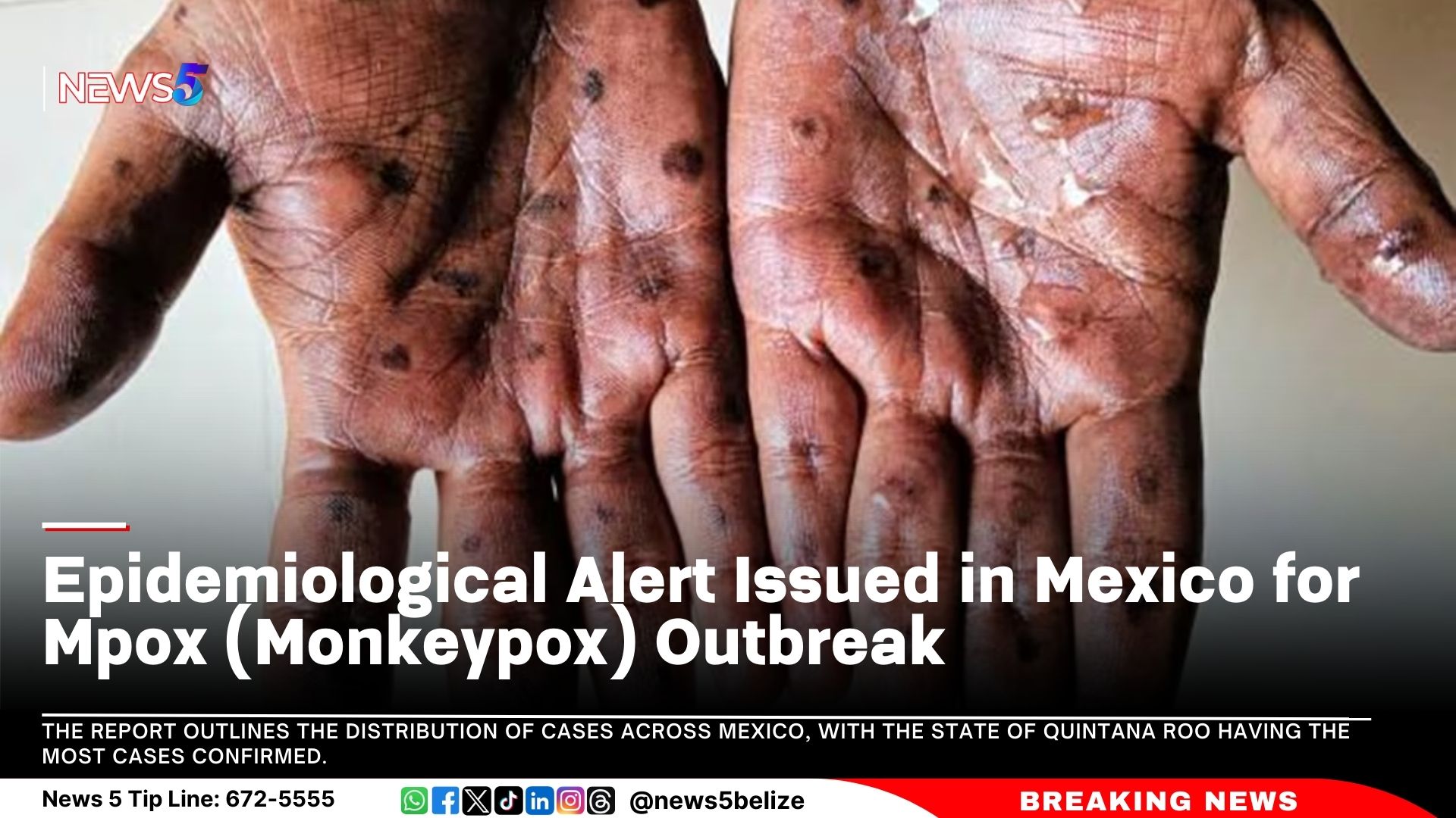 Epidemiological Alert Issued in Mexico for Mpox (Monkeypox) Outbreak