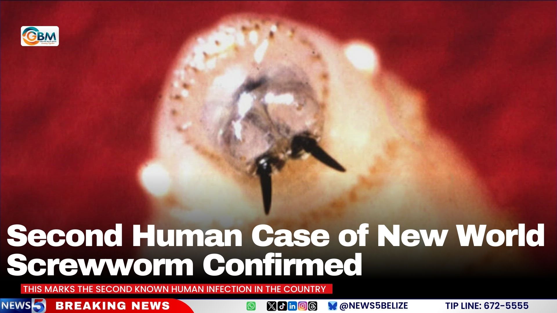 Second Human Case of New World Screwworm Confirmed