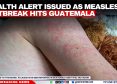 Health Alert Issued as Measles Outbreak Hits Guatemala