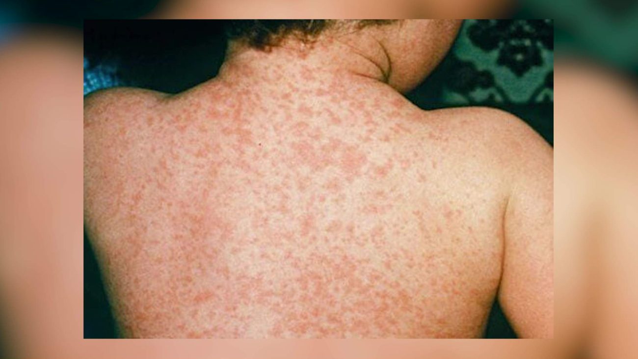 MoHW Urges Measles Vaccination as Cases Rise in Guatemala