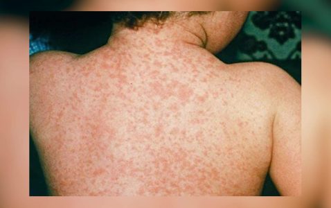 MoHW Urges Measles Vaccination as Cases Rise in Guatemala