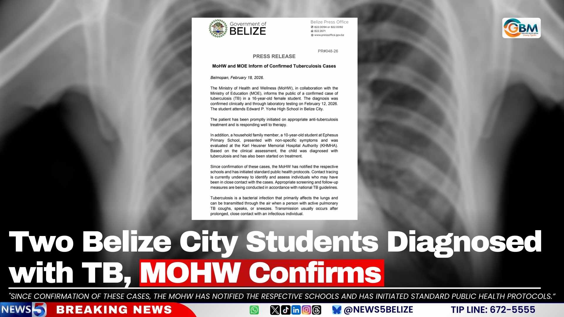 Two Belize City Students Diagnosed with TB, MOHW Confirms