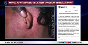 Regional Measles Spike Brings New Health Warning for Belizeans