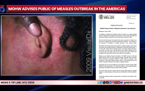 Health Officials Respond to Imported Measles Case in Punta Gorda