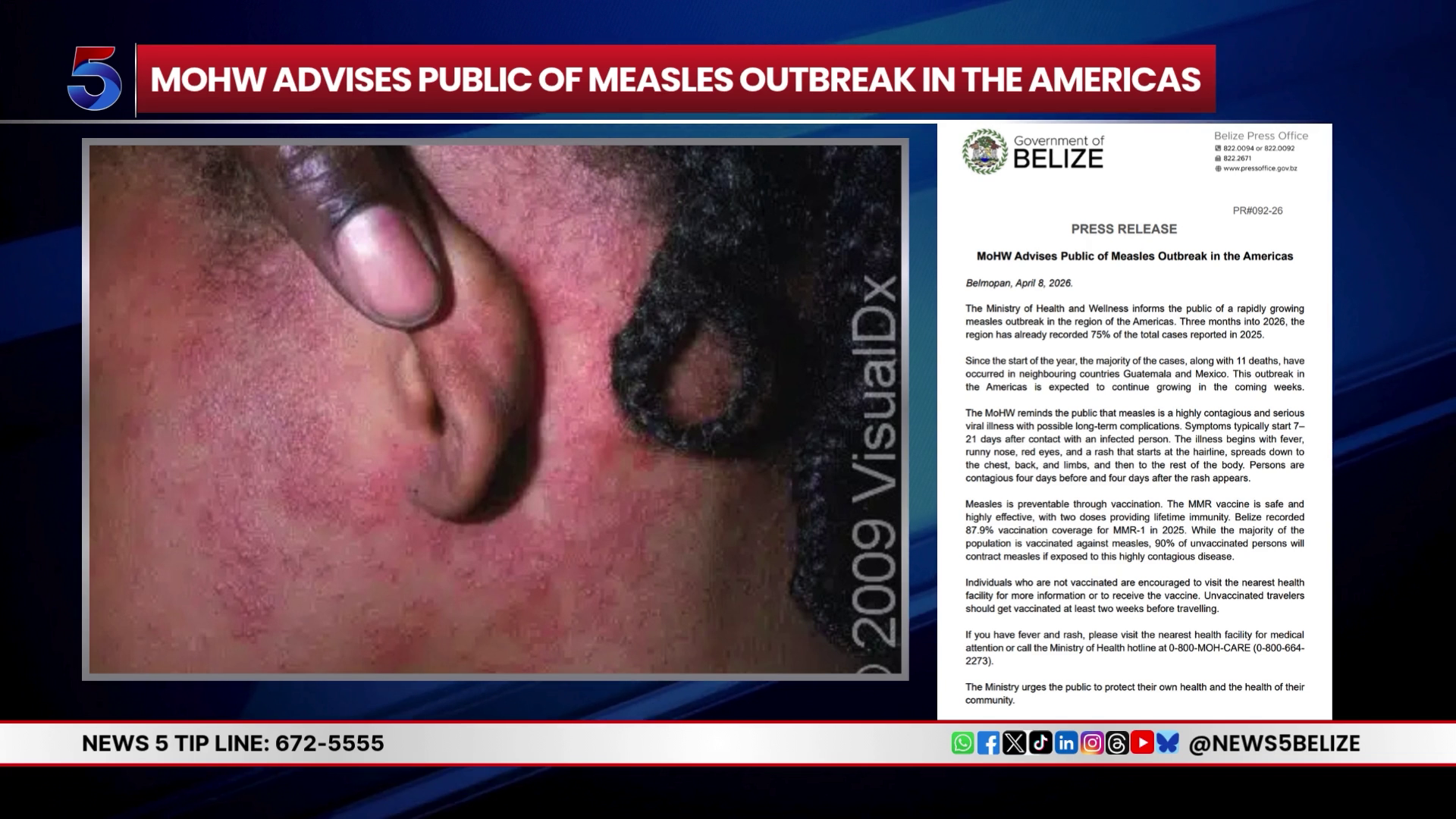 Health Officials Respond to Imported Measles Case in Punta Gorda