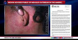 Belize on High Alert After Health Officials Confirm 12 Measles Cases