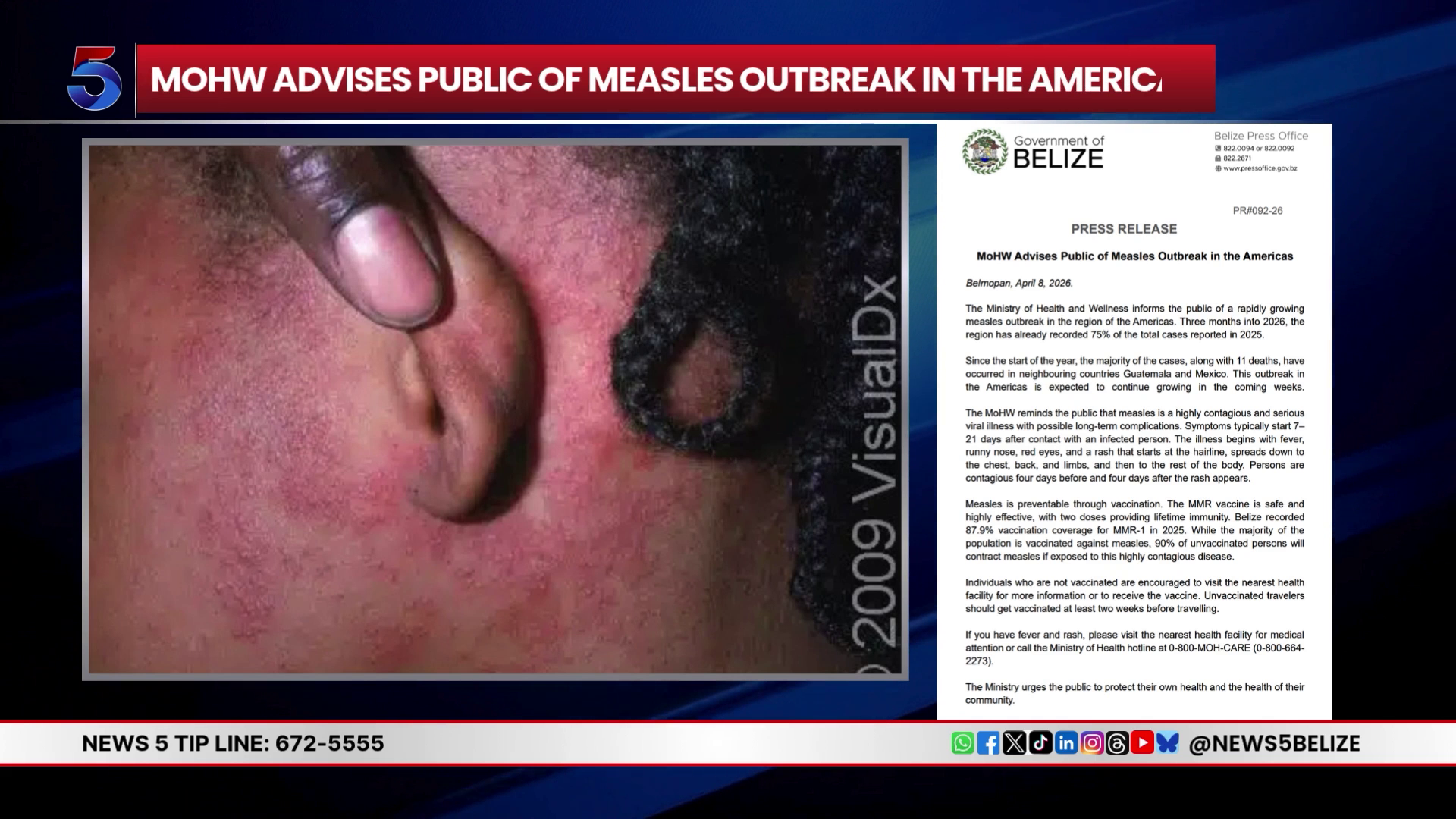 Belize on High Alert After Health Officials Confirm 12 Measles Cases