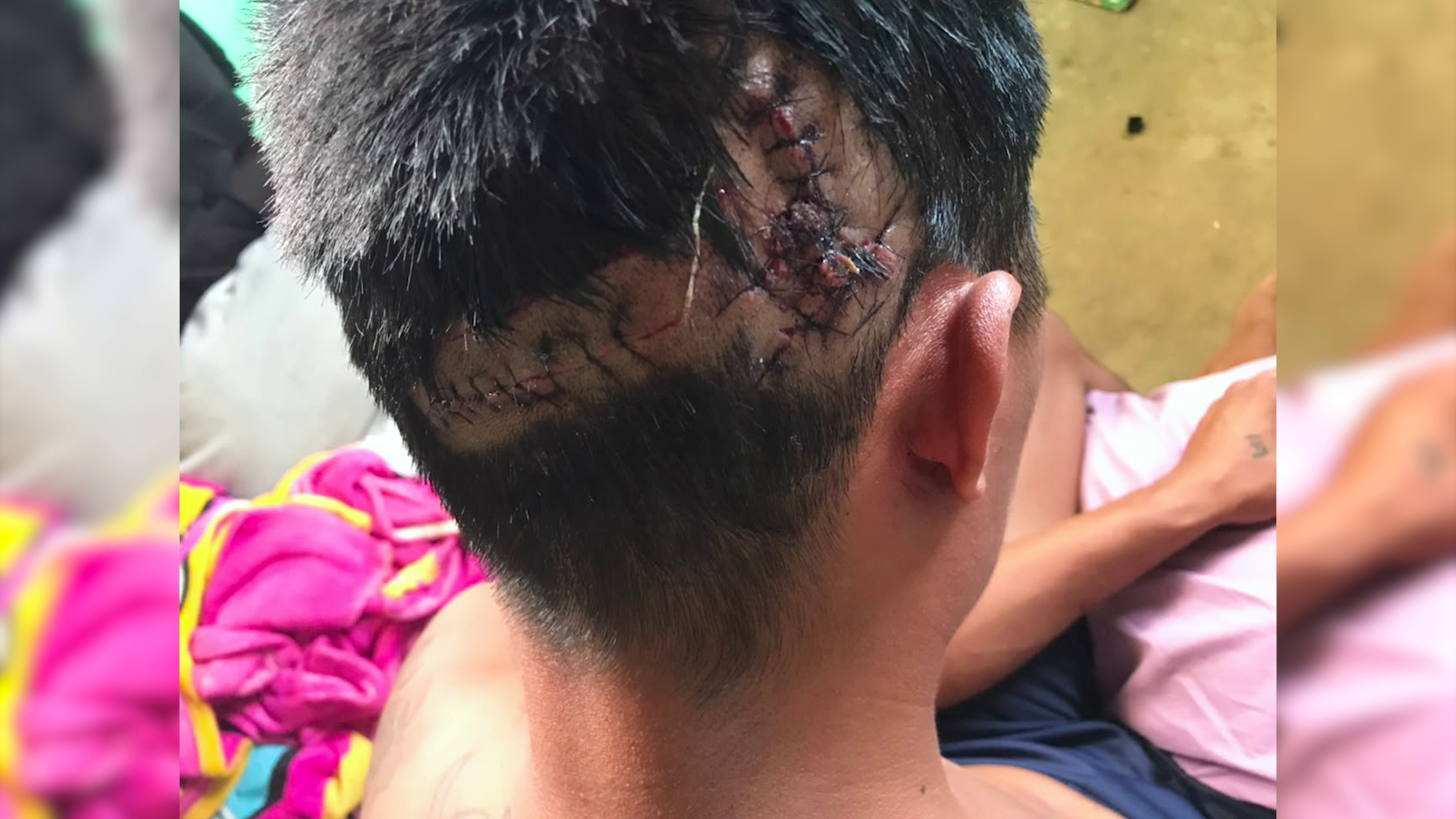 Guinea Grass Man Survives Crocodile Attack at New River Park